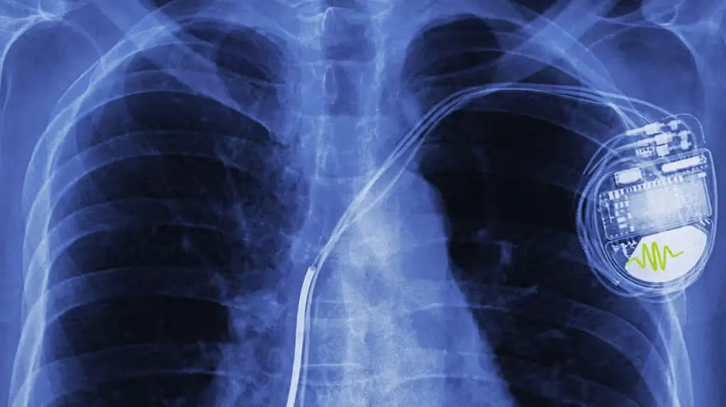 Paediatric Electrophysiology