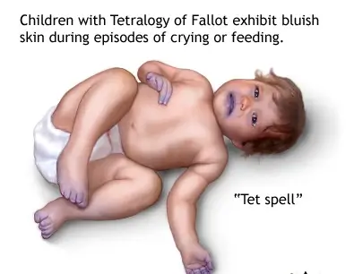 Congenital and acquired Paediatric cardiac diseases